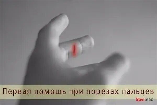 Помощь при глубоком порезе. Первая помощь при порезах пальцев. первая помощь при порезе пальца. 1 помощь при порезе пальца.