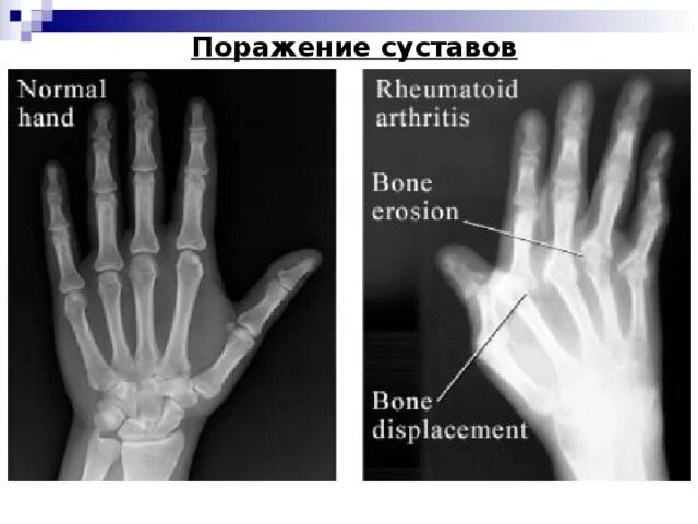 Как выглядит воспаление сустава на руке Ювенильный ревматоидный артрит признаки, причины, симптомы, лечение и профилак