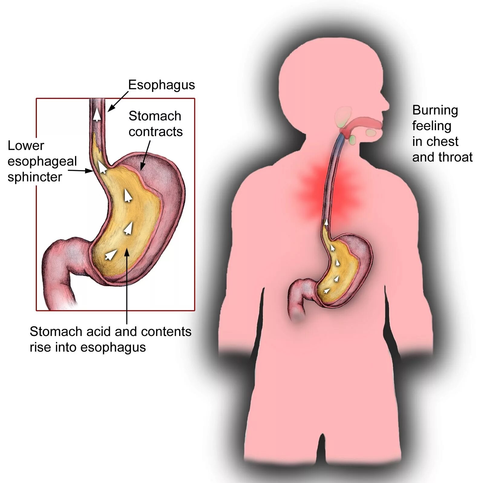 Stomach feeling. Гастроэзофагеальный рефлюкс с эзофагитом. Эзофагит рефлюкс кислотный.