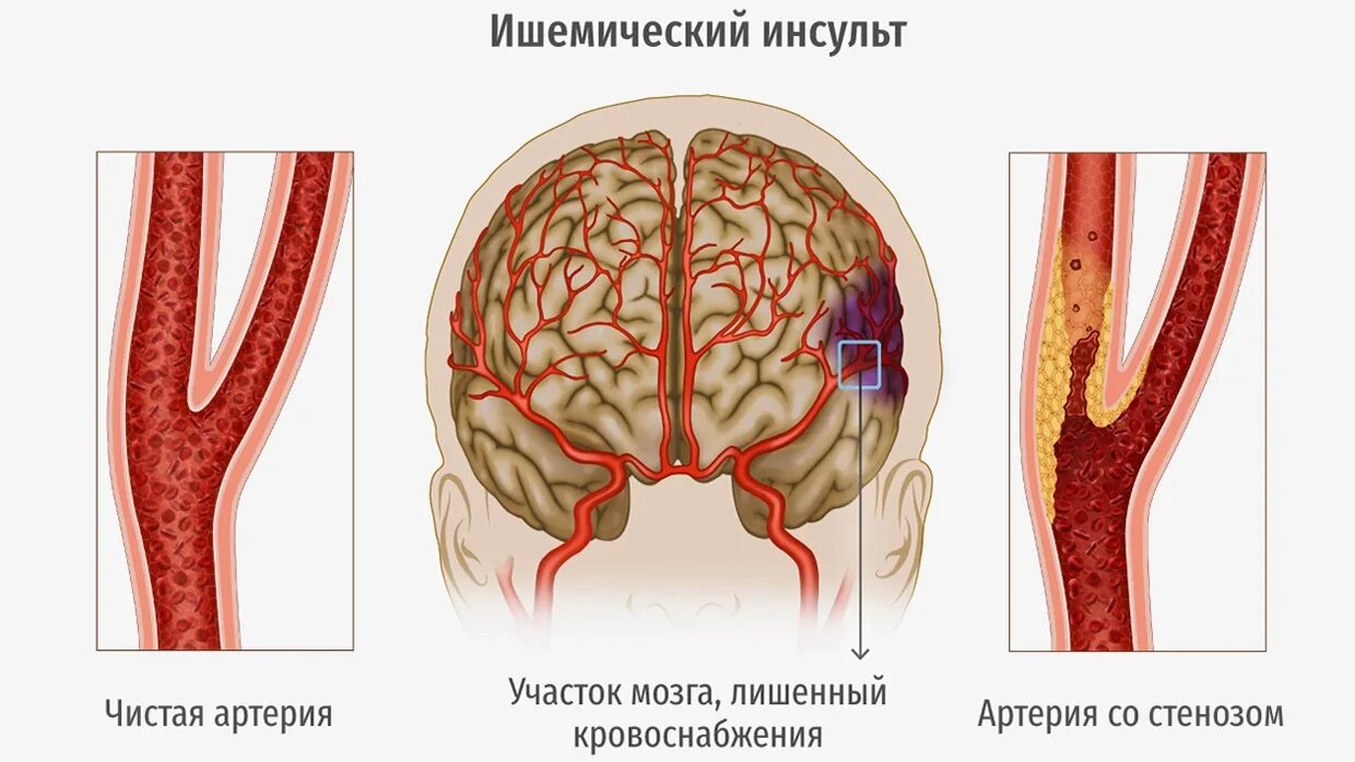 Инсульт левой артерии. Ишемический инсульт сонной артерии. Стентирование внутренней сонной артерии. Атеросклероз сосудов сонных артерий. Ишемический инсульт поражения артерий.