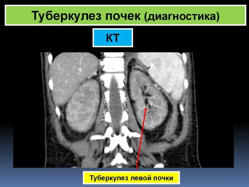 Туберкулез мочевой системы. Туберкулез паренхимы почек рентген. Кавернозный туберкулез почки кт. Кавернозный туберкулез почки экскреторная урография.