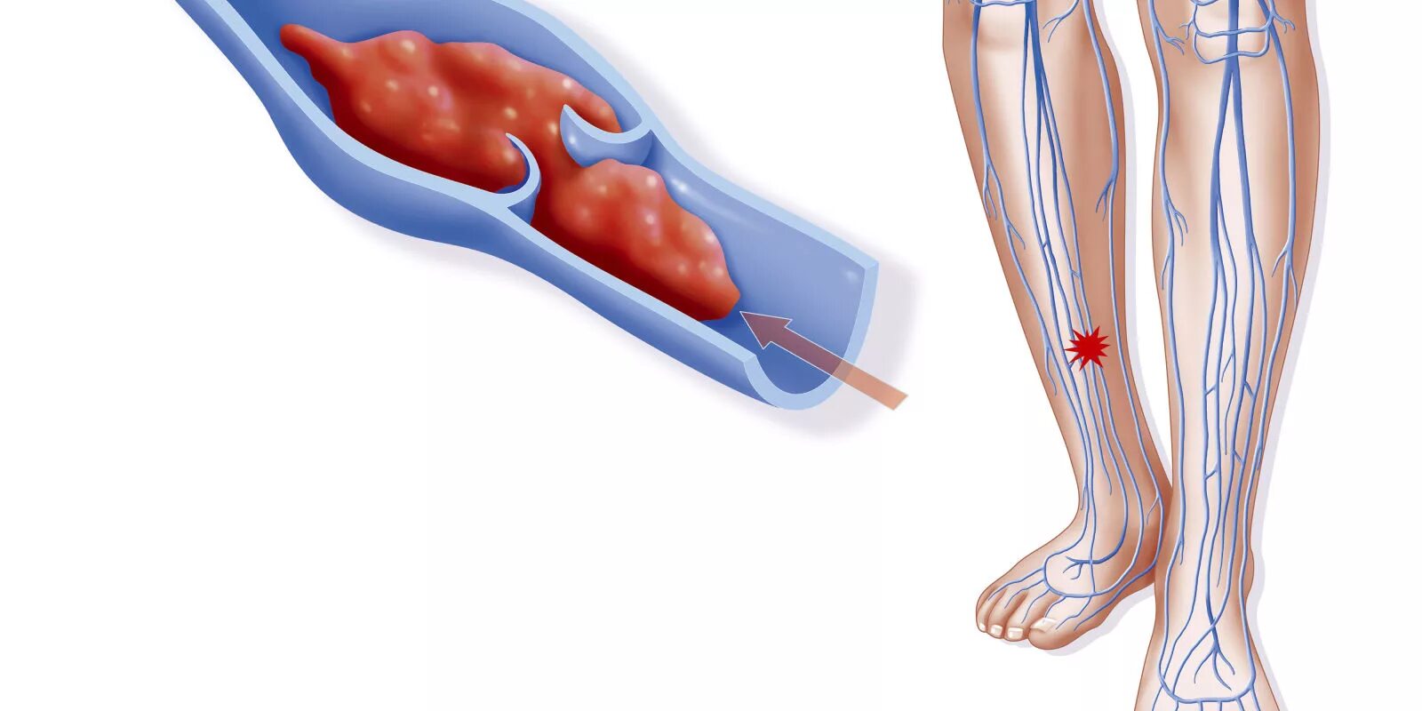 Венозный застой крови. Тромбофлебит нижних конечностей клиника. Флебит тромбофлебит глубоких вен. Трофическая язва варикозная болезнь вен нижних конечностей. Венозный тромбоз глубоких вен нижних конечностей.