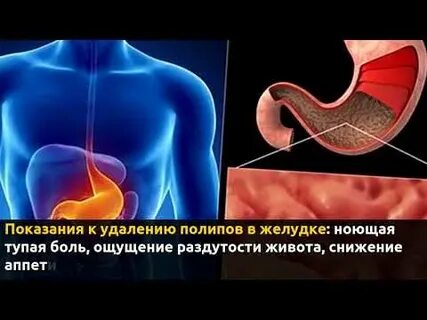 Как лечить полипы в желудке