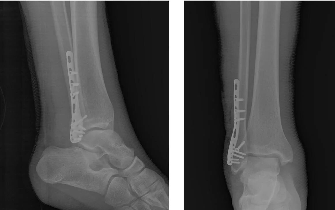 Перелом лодыжки форум вумен. Перелом наружной лодыжки рентген.
