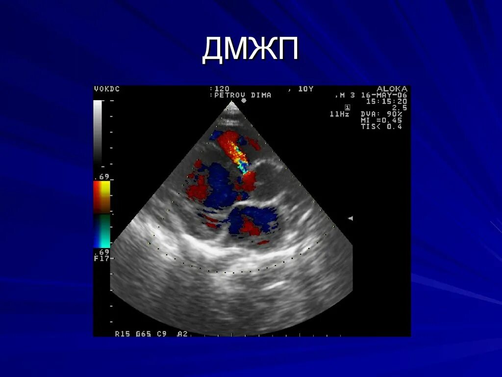 Впс дмжп у детей. Субтрикуспидальный дефект межжелудочковой перегородки. перимембранозный дефект межжелудочковой перегородки. подаортальный дефект межжелудочковой перегородки. дмжп эхокг.