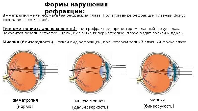 Аномалии рефракции глаза астигматизм. Эмметропия миопия гиперметропия. Аномалии рефракции: дальнозоркость, близорукость, астигматизм.. Схема глаза эмметропии. Миша страдает близорукостью а его брат дальнозоркостью