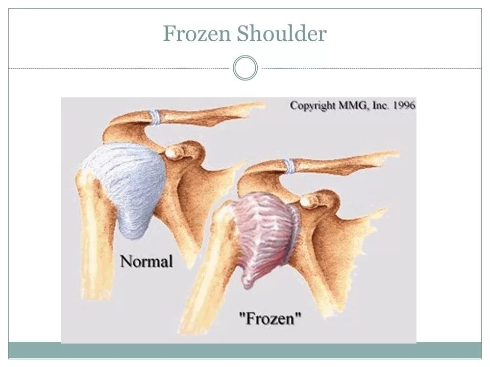 плечелопаточный периартрит периартроз. периартрит плечелопаточного сустава. периартроз плечевого сустава патогенез. плечелопаточный полиартрит. периартрит плечевого сустава.