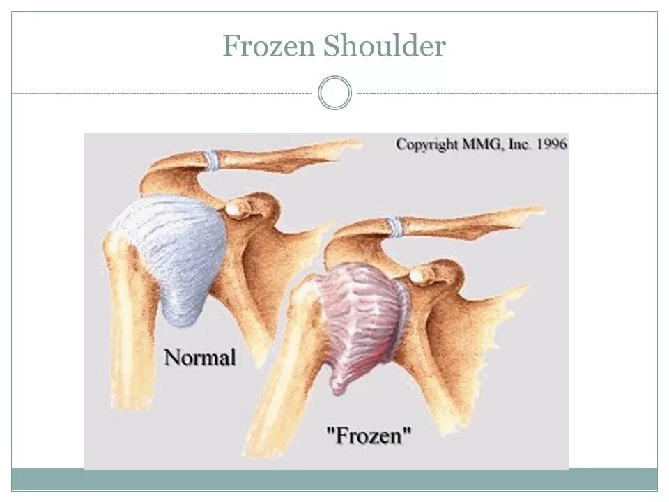 Капсулит плечевого сустава. Суставной капсулит плечевого сустава. Адгезивный капсулит плечевого сустава. Капсулит анкилозирующий.