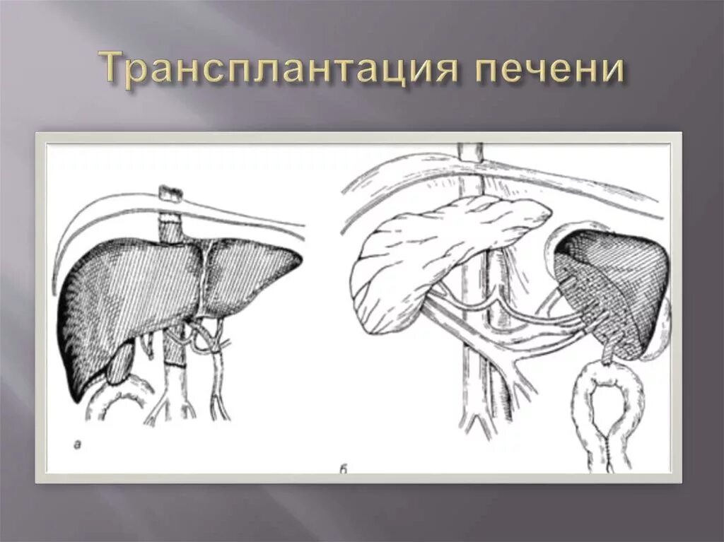 Классическая техника ортотопической трансплантации печени. Piggyback трансплантация печени. Трансплантация печени анастомоз. Трансплантация печени схема. Можно ли пересадить печень