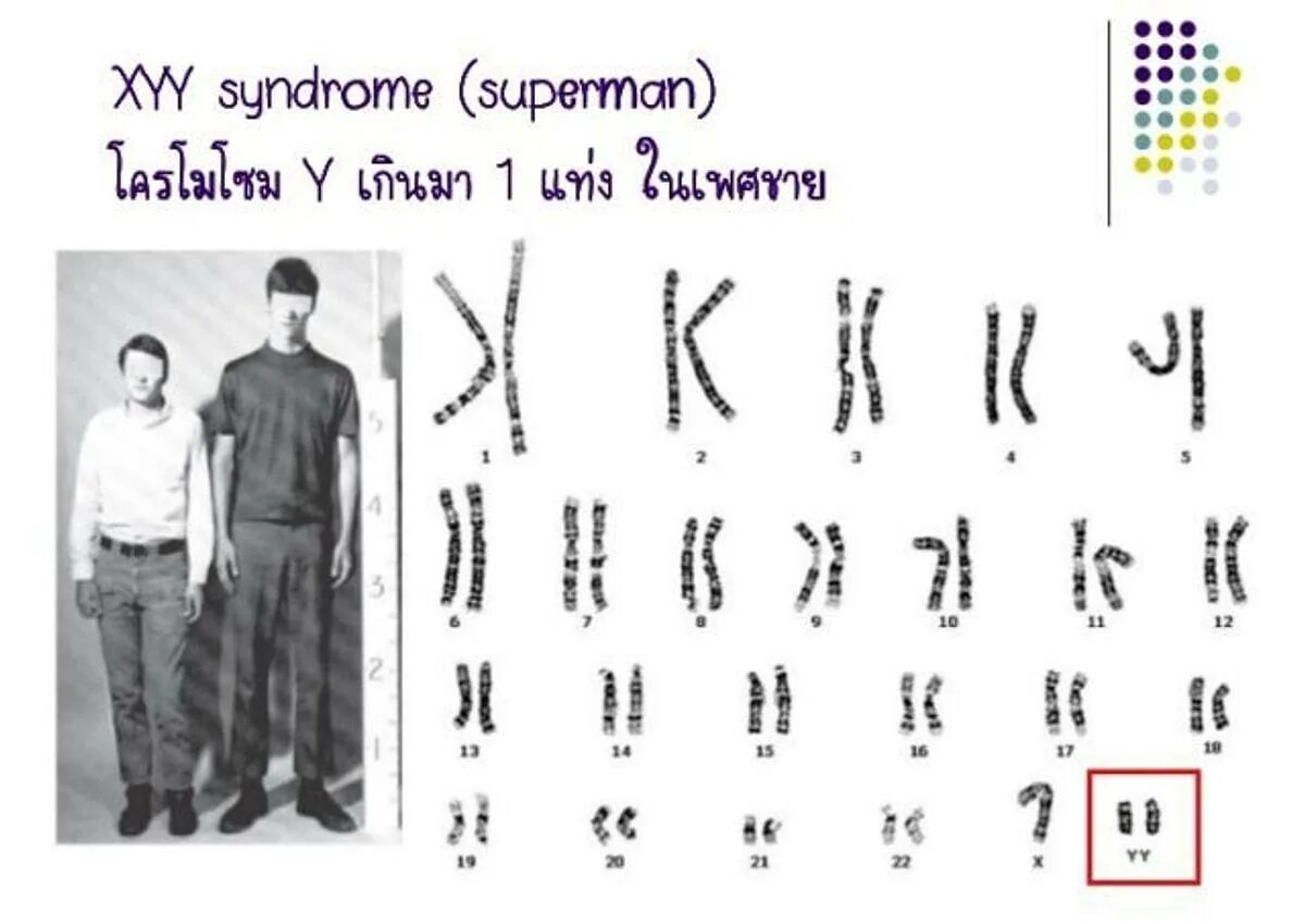Синдром удвоения y-хромосомы. Кариотип 47 хуу синдром. 47 XYY кариотип.