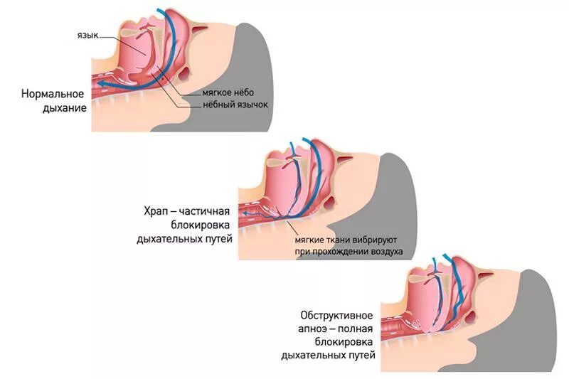 Почему появляется храп. Храп и синдром обструктивного апноэ сна. Причины возникновения храпа. Остановка дыхания во сне. Храп механизм возникновения.