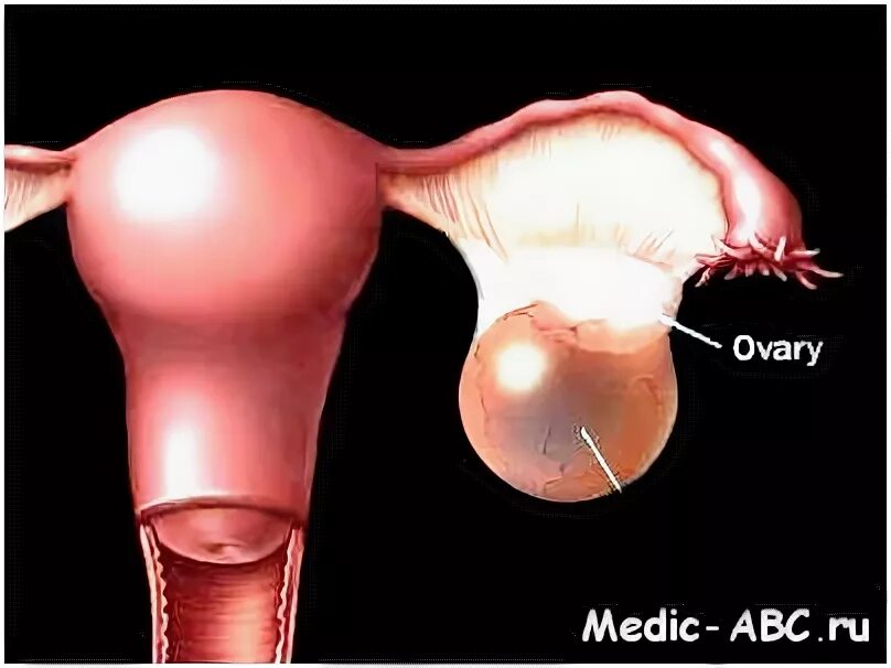 Яичник у мужчин лечение. Киста яичника кальцинированная. Дельтовидная киста яичника. Киста правого яичника 3 мм. Реконвалесцент кисты яичника.