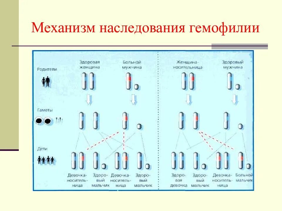 Гемофилия Тип наследования. Тип наследования при гемофилии Тип с. Кариотип больного гемофилией. Гемофилия кариотип формула.