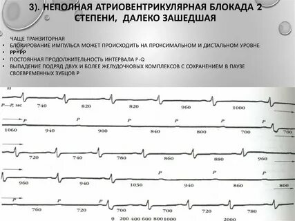 Атриовентрикулярная блокада 2