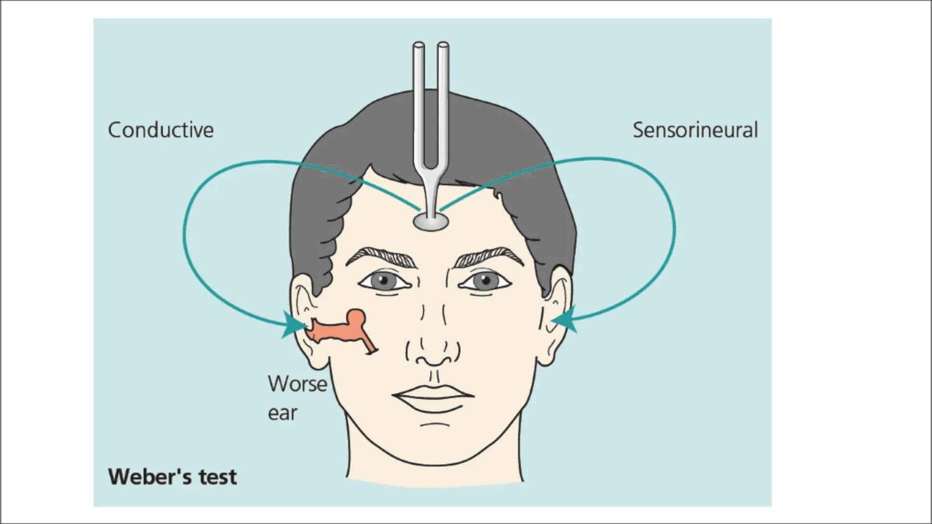 Тест Вебера и Ринне. Камертональное исследование слуха. Камертональные пробы. Опыт Вебера при кондуктивной тугоухости.