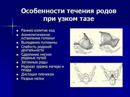 Роды при узком тазе