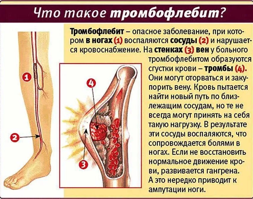 Пронация стопы гиперпронация. Тромбофлебит подколенной вены. Как распознать в ноге. Тромбо. Тромбофлебит нижних конечностей.