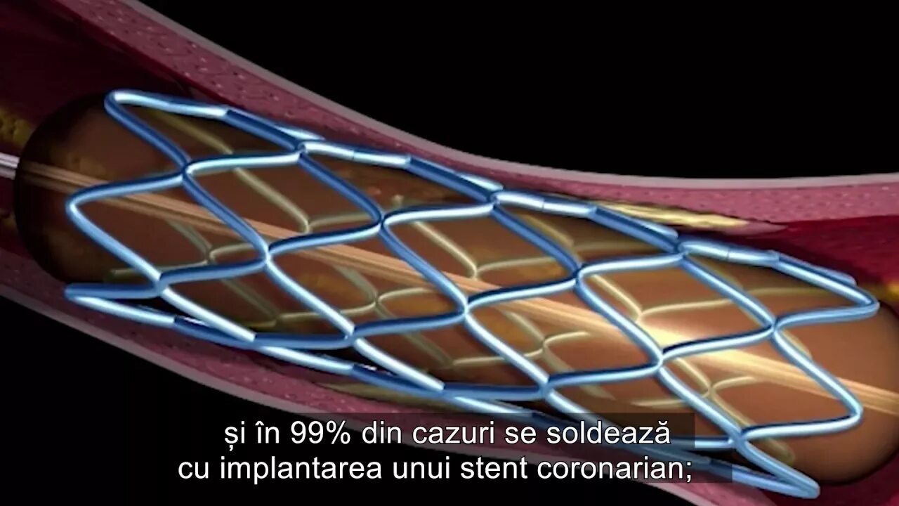 Стентирование самолет. Операция стентирование сосудов сердца. стентирование сосудов при тромбозе. лазерная ангиопластика. изолированное стентирование.
