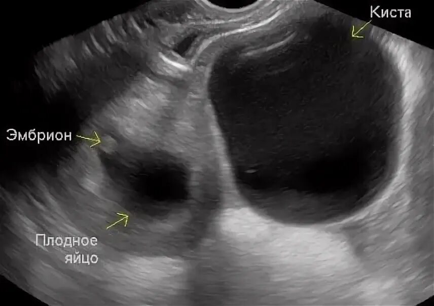 Тянет яичник при беременности на ранних. Фолликулярная киста яичника на УЗИ.