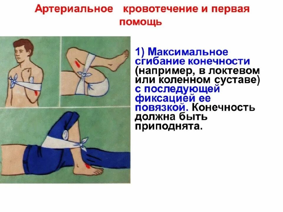 1 помощь при артериальном кровотечении конечностей. Артериальное кровотечение пмп. порядок пмп при артериальном кровотечении. артериальное кровотичениепервая помощь. первая помощь при аптериальном крово.