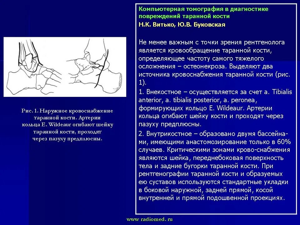 Стадии асептического некроза таранной кости кт. Асептический некроз таранной кости. Аваскулярный некроз таранной кости. Повреждение таранной кости.