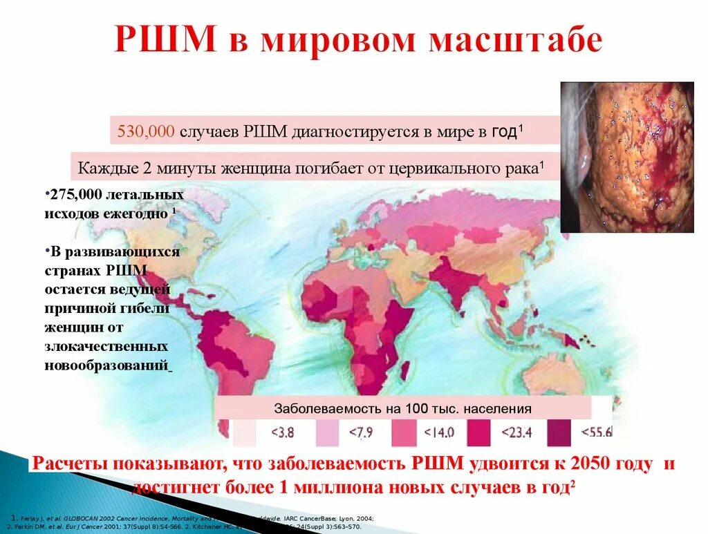 Рак шейки матки 3 стадия сколько