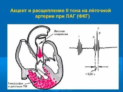 Расщепление тонов