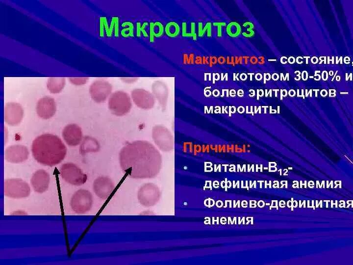 Пониженные макроциты. Микроцитоз цитоморфологические признаки. Микроцитоз эритроцитов причины. Макроциты и микроциты. Микроцитоз характерен для анемии.