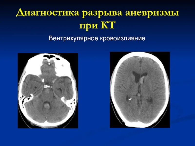 Аневризма перегородки у ребенка. Разрыв аневризмы кт мозга. Аневризмы головного мозга кт. Аневризма головного мозга на кт. Вентрикулярное кровоизлияние головного мозга.