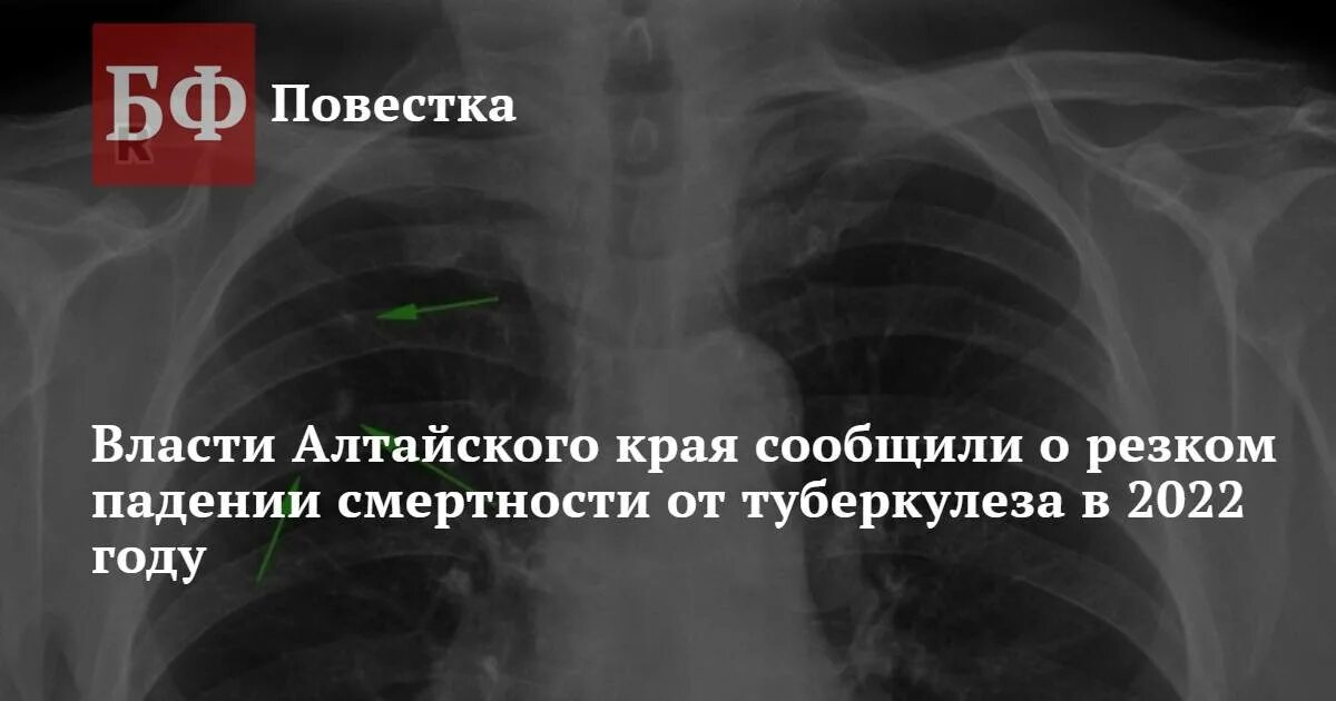 Туберкулез 2022 года. Диссеминированный туберкулез процент летальности. Туберкулез костей смертность.