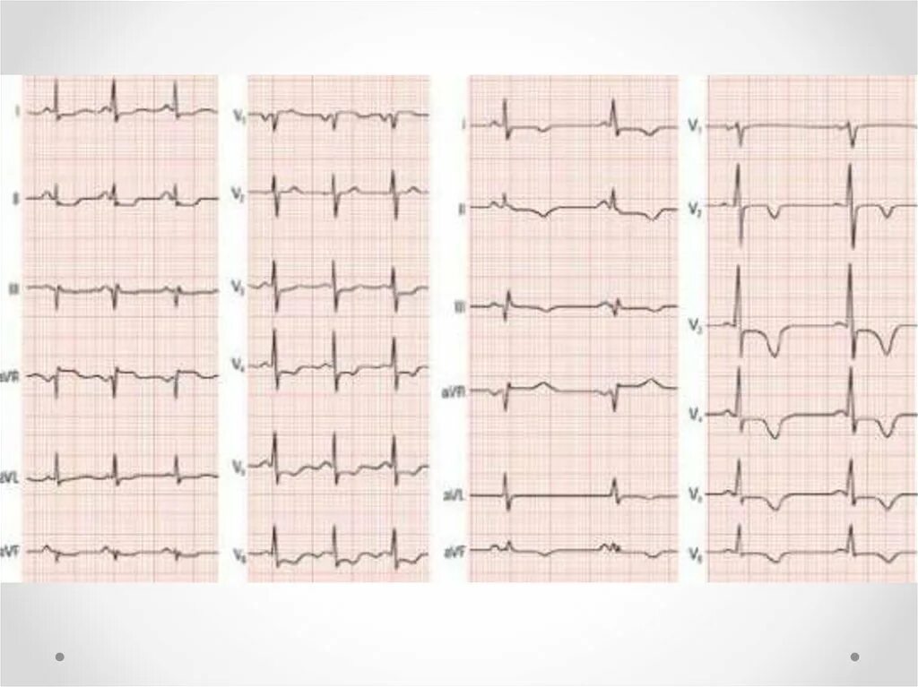 Депрессия сегмента st. Элевация St 2,3, AVF. Элевация сегмента St на ЭКГ В грудных отведениях. Депрессия St v4-v6 ЭКГ. Депрессия сегмента St на ЭКГ v5 v6.