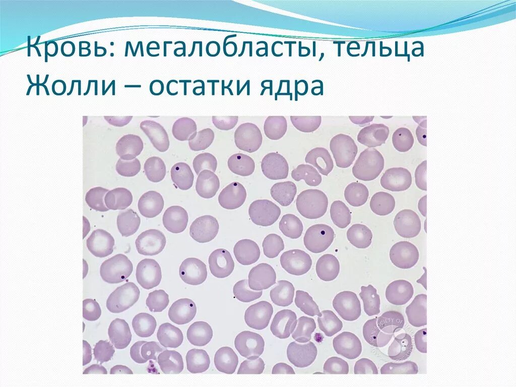 Тельца Жолли и кольца Кебота. Тельца Хауэлла Жолли. Тельца Говелла Жолли анемия. Кольца Кебота и тельца Жолли анемия. Многочисленные мелкие тельца