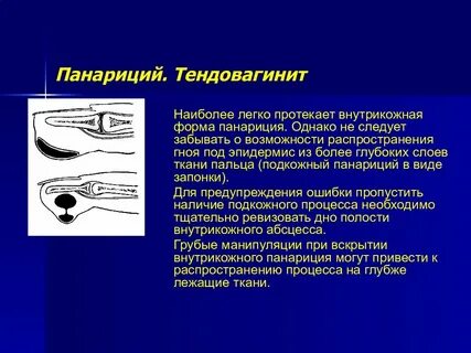 Панариция какой мазью лечить