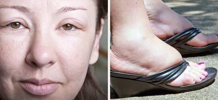 Отеки лица и ног причины у женщин. Ножки летом. Отеки лица и ног причины у женщин. Отеки лица и ног причины у женщин. Отеки лица и ног причины у женщин.