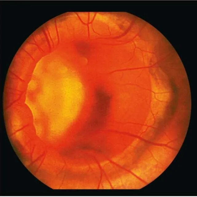 Аномалия развития зрительного нерва. Колобома сосудистой оболочки. Колоболие зрительного нерва.