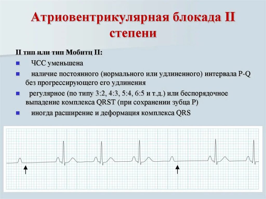 Атриовентрикулярная блокада 2. Атриовентрикулярной блокады 2 степени типа Мобитц 1. ЭКГ av блокада Мобиц 2. Атриовентрикулярная блокада 1 Тип. Атриовентрикулярная блокада 2 степени 1 типа.