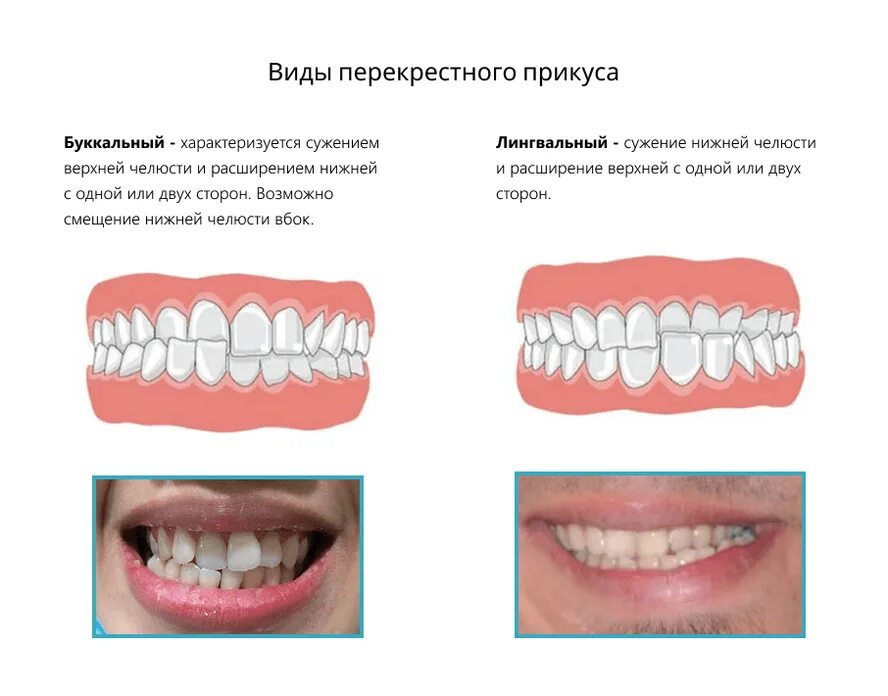 Перекрестные зубы