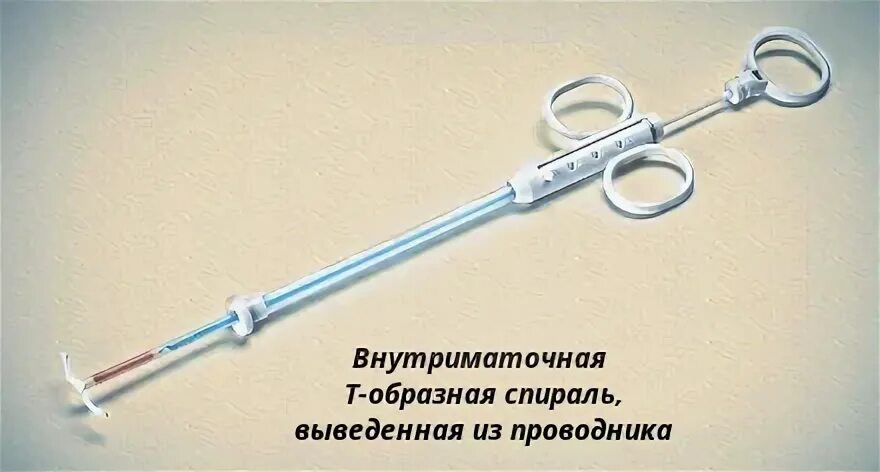 Спираль кайлина внутриматочная отзывы