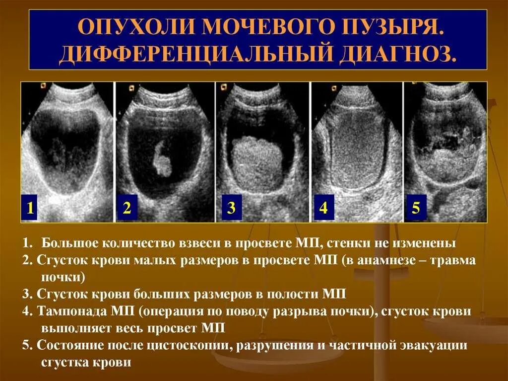 Опухоли мочевогоп пузыря. Объемное образование мочевого пузыря. Новообразование в мочевом. Доброкачественная опухоль мочевого пузыря. Ршм рецидивы