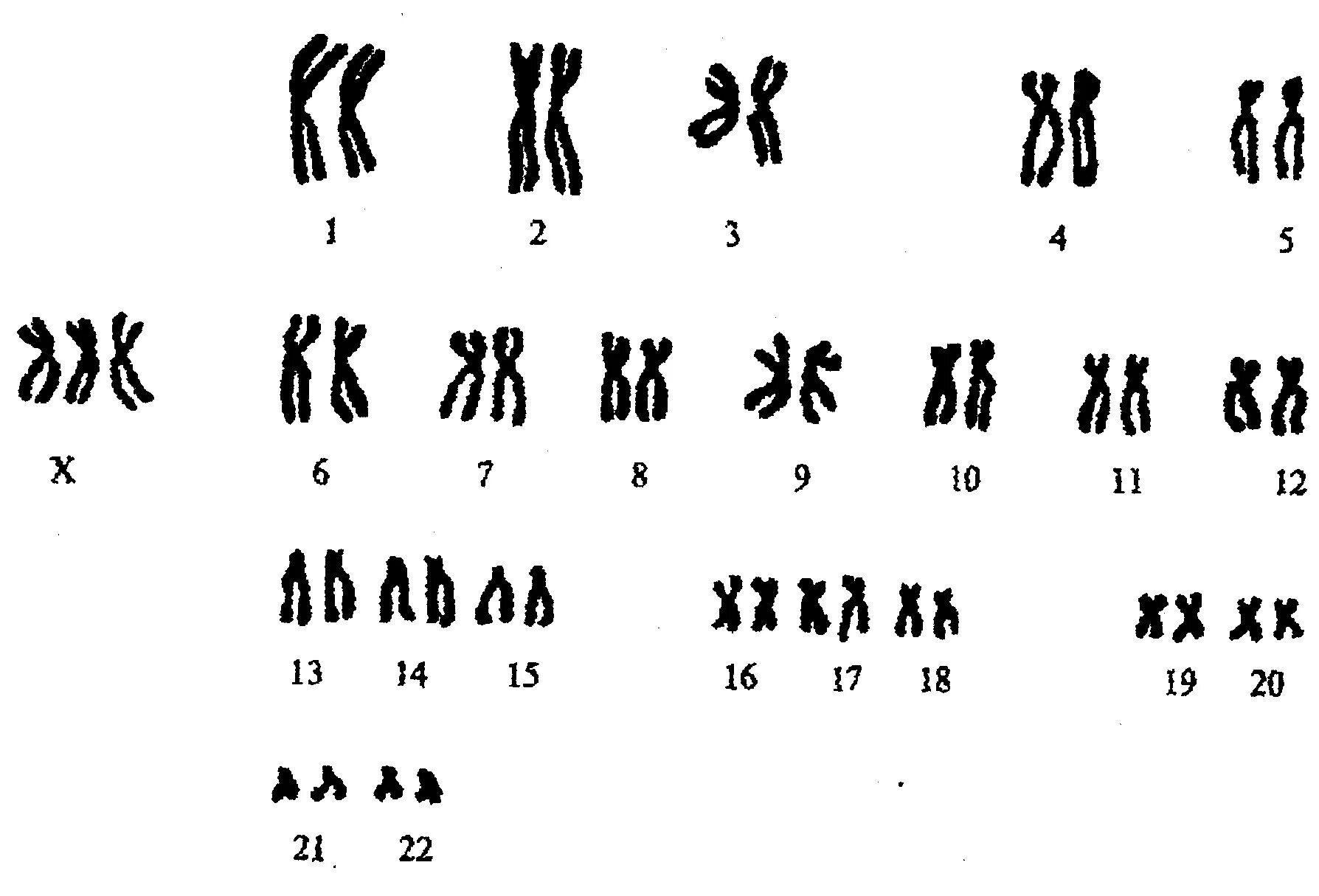Кариотип фенотип. Кариотип и фенотип человека. Синдром трисомия х кариотип. Основной признак синдрома патау. Схема наследования синдрома патау.