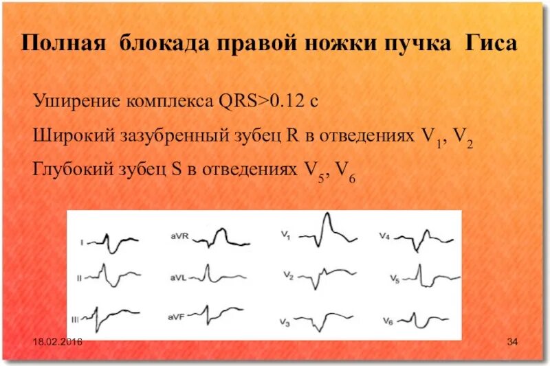 Гиса блокада пнпг. Блокада правой ножки пучка Гиса 2 отведение. Описание ЭКГ при блокаде правой ножки пучка Гиса. Блокада правой ноги QRS. Полная блокада правой ножки пучка Гиса.