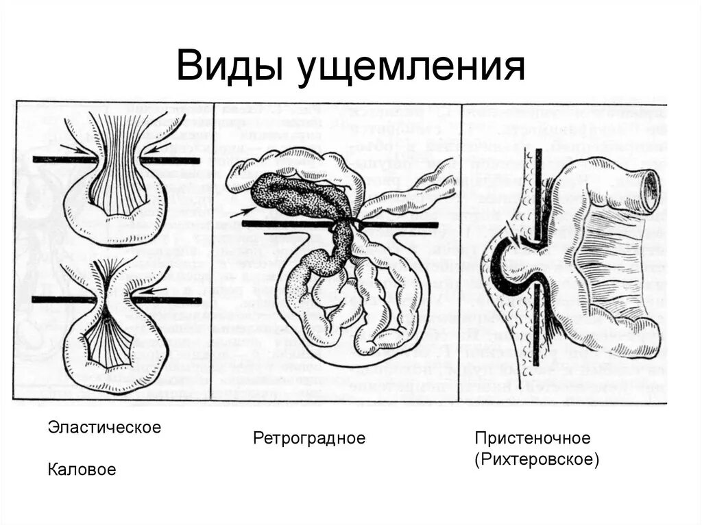 Эластическое ущемление грыжи механизм. Антеградное ущемление грыжи. Ретроградное ущемление (грыжа Майдля). Механизм калового ущемления грыжи.