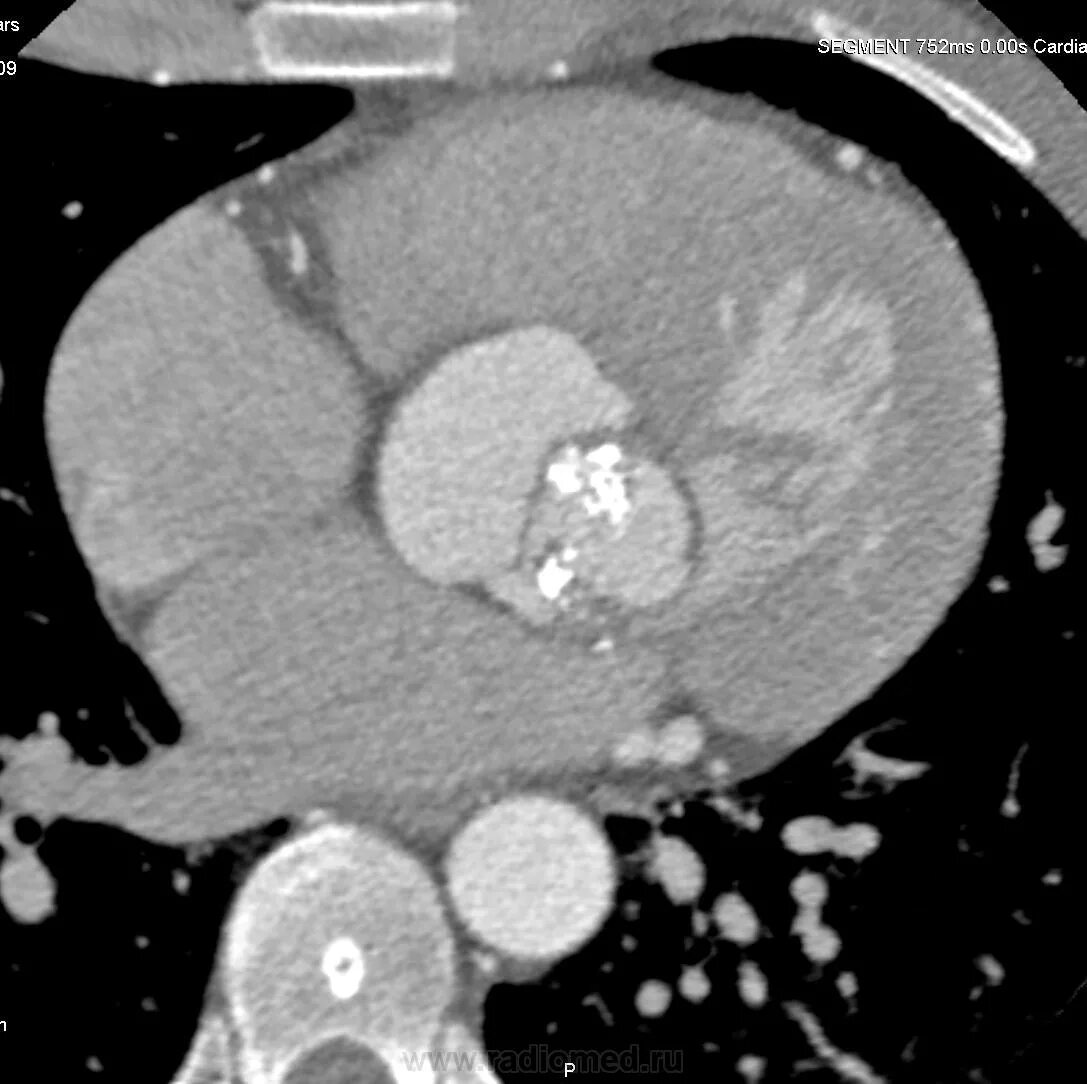 Кальциноз митрального клапана. Двустворчатый аортальный клапан на кт. Кальциноз митрального клапана на кт. Стеноз аортального клапана кт. Кальциноз аортального клапана кт.