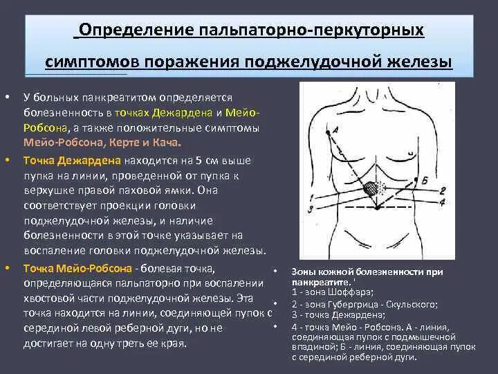 Точки болезненности. Симптомы хронического панкреатита Мейо Робсона. Острый панкреатит симптом Мейо Робсона. Симптомы острого панкреатита Мейо Робсона Воскресенского. Зона Шоффара и точка Мейо Робсона.