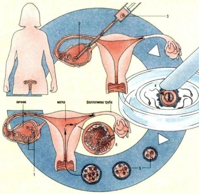 Без труб можно забеременеть естественным. Искусственное оплодотворение. Искусстсвенноеоплодотворение. Эко оплодотворение. Эко экстракорпоральное оплодотворение.