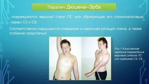 Парез эрбе