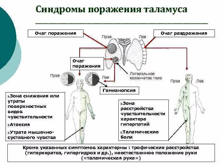 Симптомы и синдромы поражения. Синдром поражения зрительного бугра. Зрительный бугор симптомы поражения неврология. Нарушение чувствительности при поражении таламуса. Расстройства чувствительности при поражении таламуса.