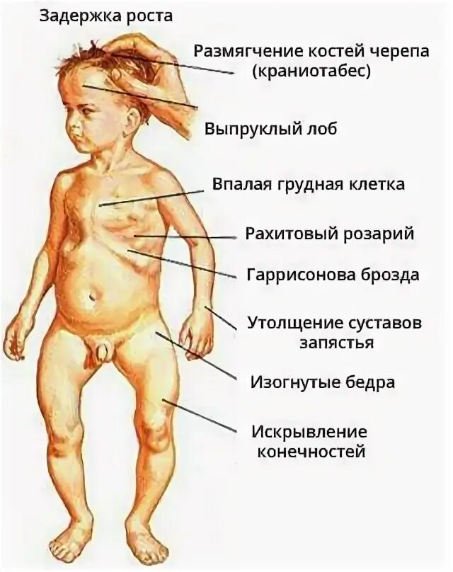 Симптомы рахита у детей 6 месяцев. Рахит у новорожденных в 2 месяца. Рахит симптомы у детей 1 год. Рахит у детей грудничков симптомы. Рахит в 6