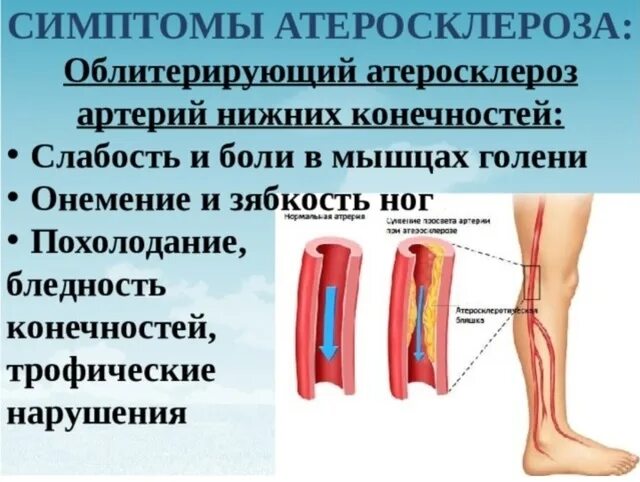 Симптомы зажатых сосудов. Основные симптомы атеросклероза артерий нижних конечностей.
