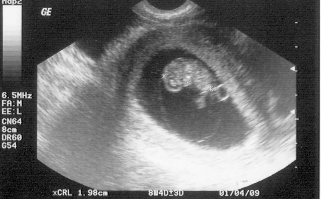 5 акушерская неделя. 7 Акушерских недель беременности размер. 7 Недель беременности размер плода фото УЗИ. 7 Недель беременности симптомы ощущения. 5 Недель беременности размер плода фото.